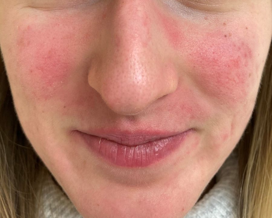 MF-Po-6-měsících-léčby