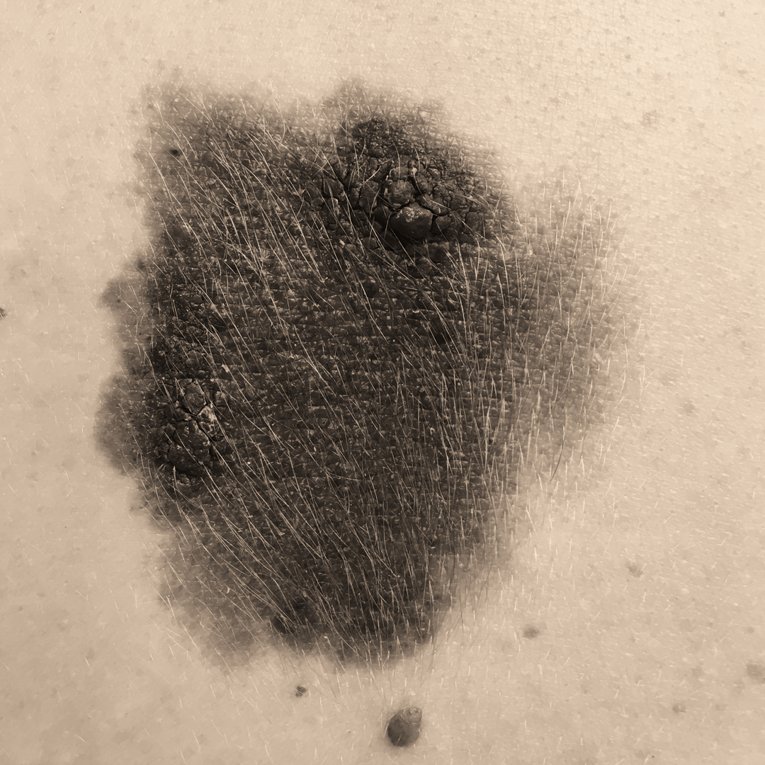 Pigmentová znaménka