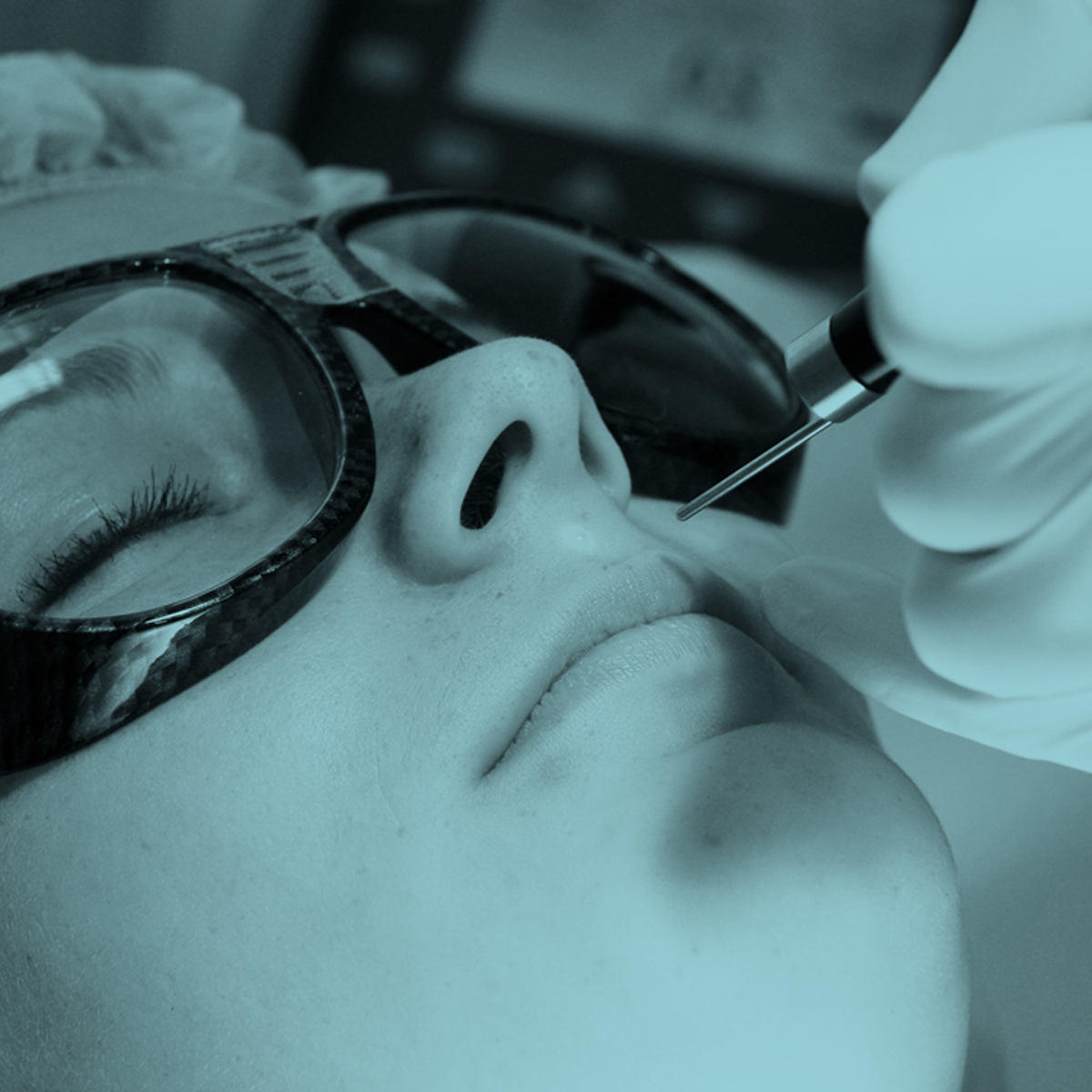 Odstranění útvarů CO2 laserem