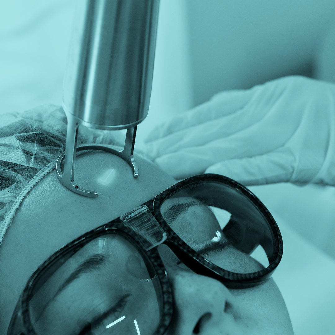 Frakční CO2 rejuvenace