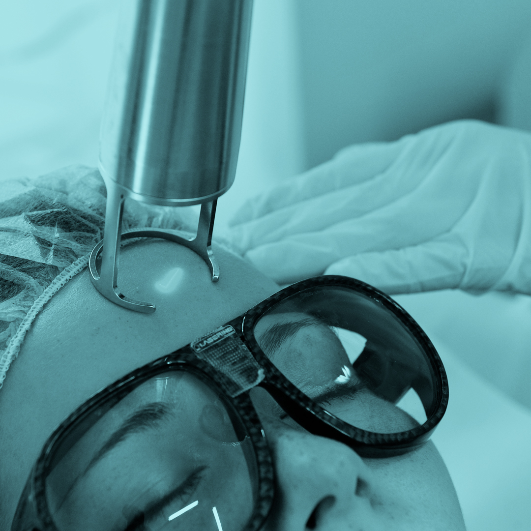 Frakční CO2 rejuvenace