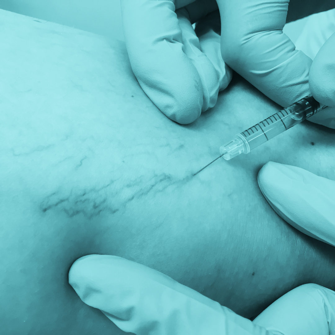 Rozšířené žilky na nohou